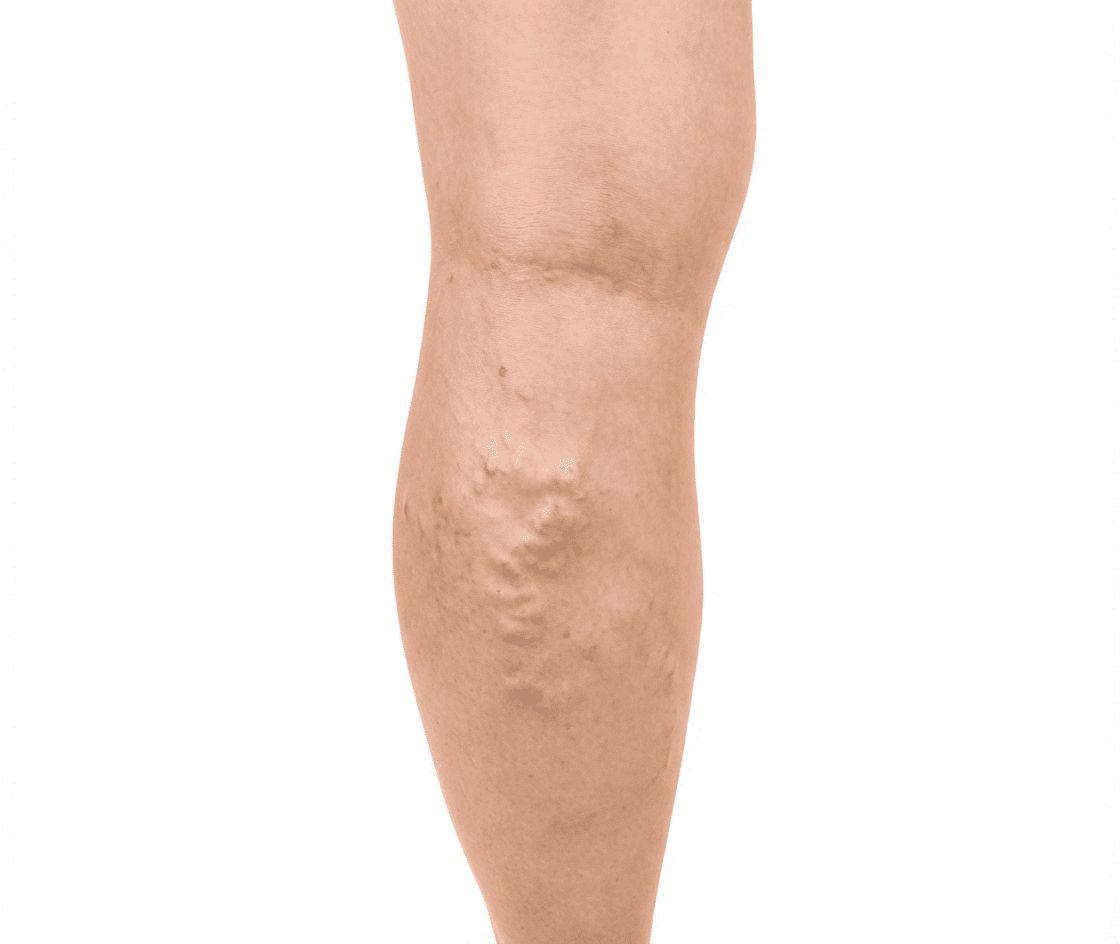 Veins Before